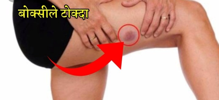 शरिरमा देखिने निलो दाग बो’क्सीले टोकेर हो ?? यस्तो छ रहस्य