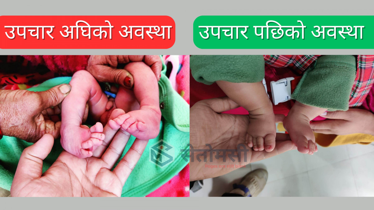 जन्मदै बाङ्गो खुट्टाे भएको बच्चाको गुल्मी अस्पतालमा सफल उपचार